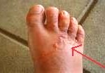 hookworm2-150x104