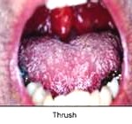 thrush2-150x140