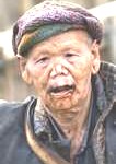 an unfortunate leper with a disfigured face