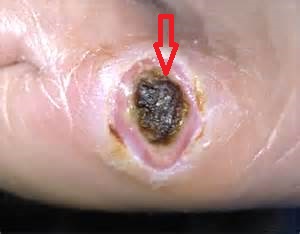(a scab on a wound)